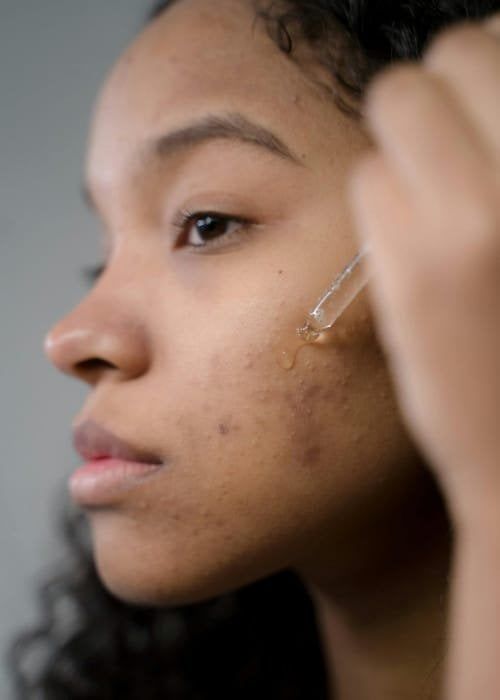 Applying serum on facial skin with acne.